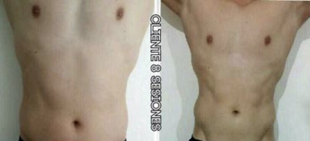 Eliminaciónde tejido adiposo en cintura y abdomen